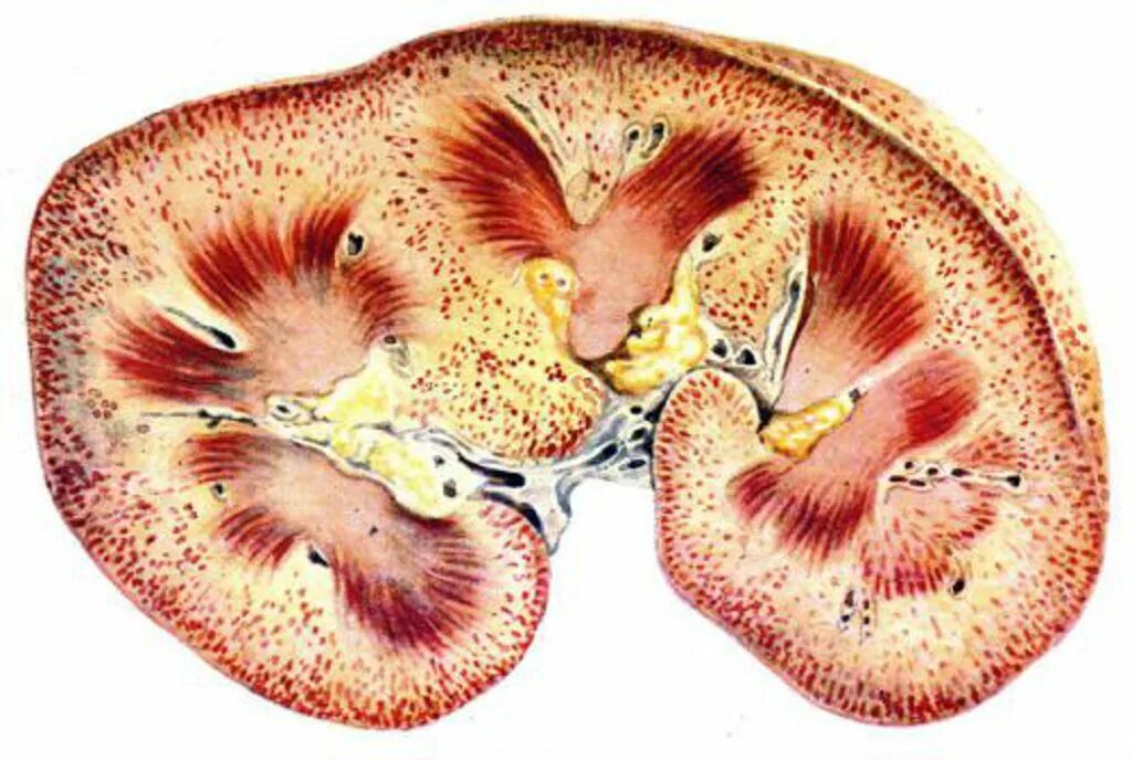 Острый диффузный гломерулонефрит. Липоидный нефроз почки. Некротический нефроз патанатомия макропрепарат. Слизистые оболочки почек