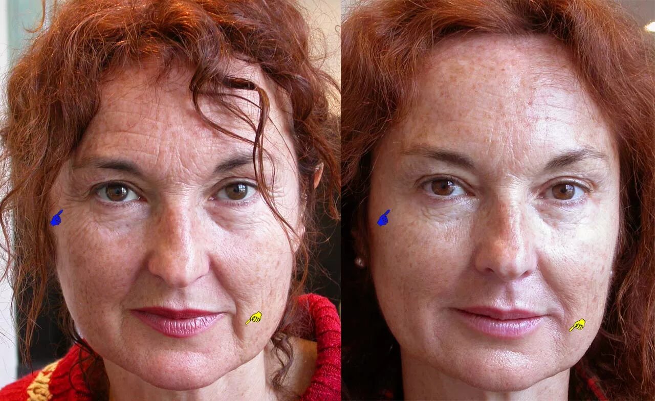Ботокс для лица до и после. Биоревитализация под глазами. Уколы красоты для лица до и после. Уколы красоты для лица после 40.