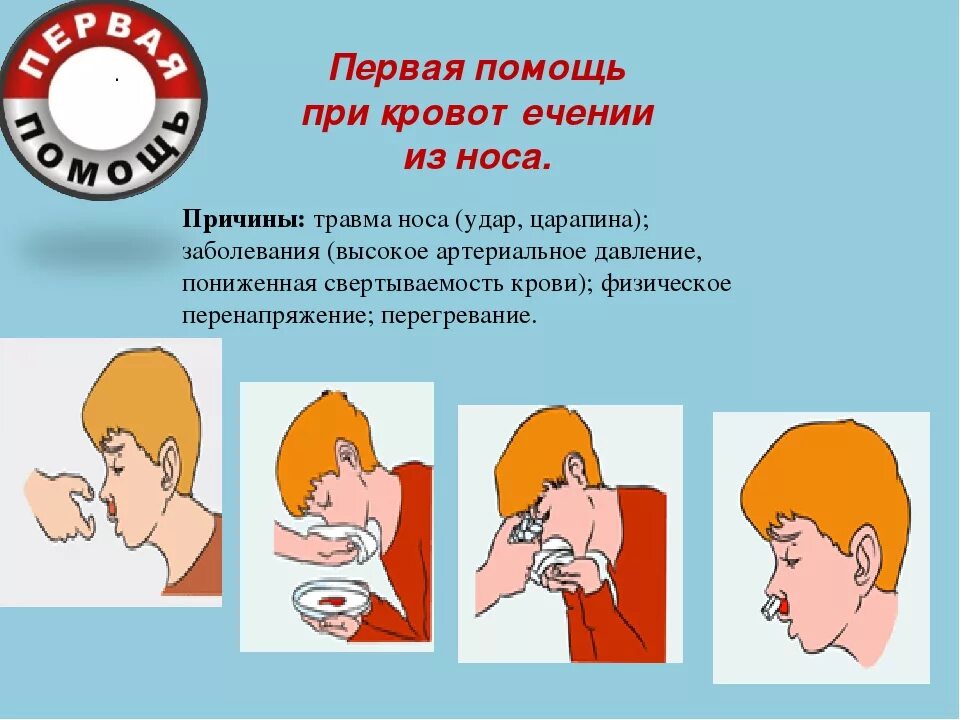 Первая помощь при кровотечении из носа. Оказание помощи при кровотечении из носа. При кровотечении из носа. Оказание первой помощи при травме носа.