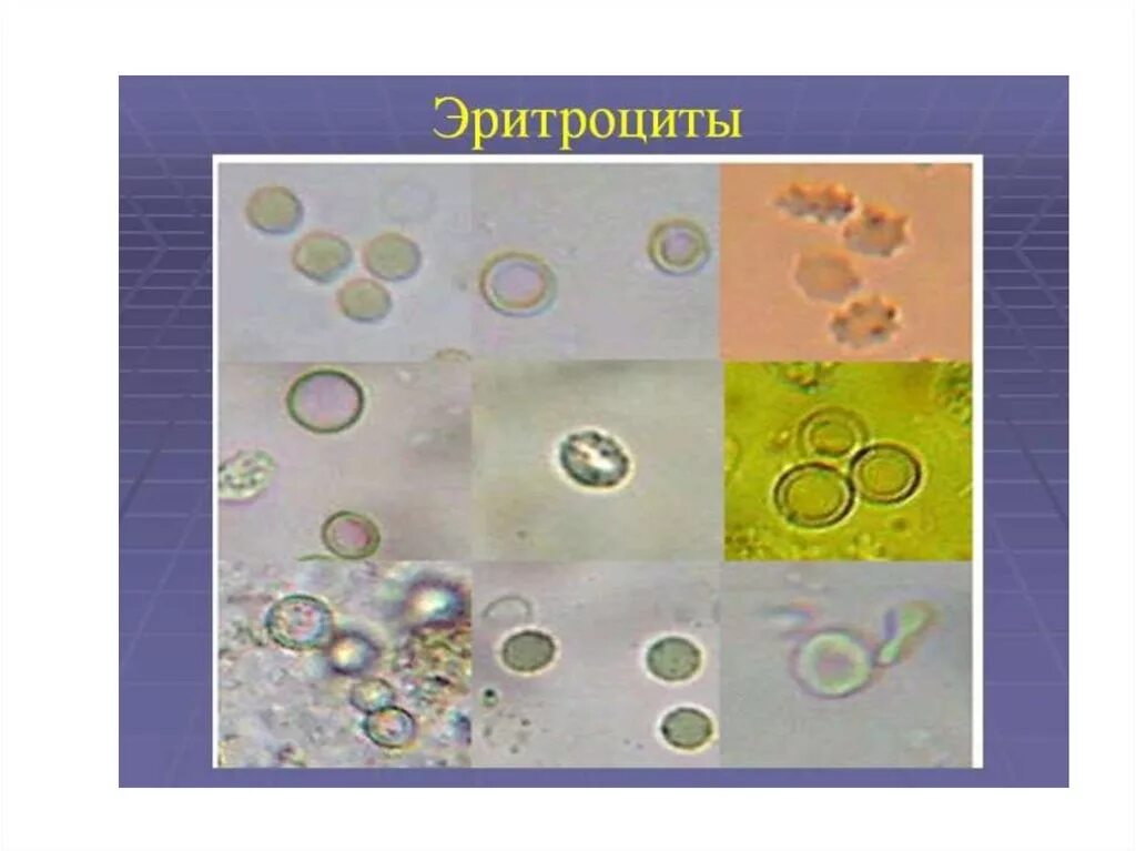 Сплошь эритроциты в моче. Микроскопия кала эритроциты. эритроциты в кале под микроскопом. лейкоциты в кале под микроскопом. измененные эритроциты в моче.