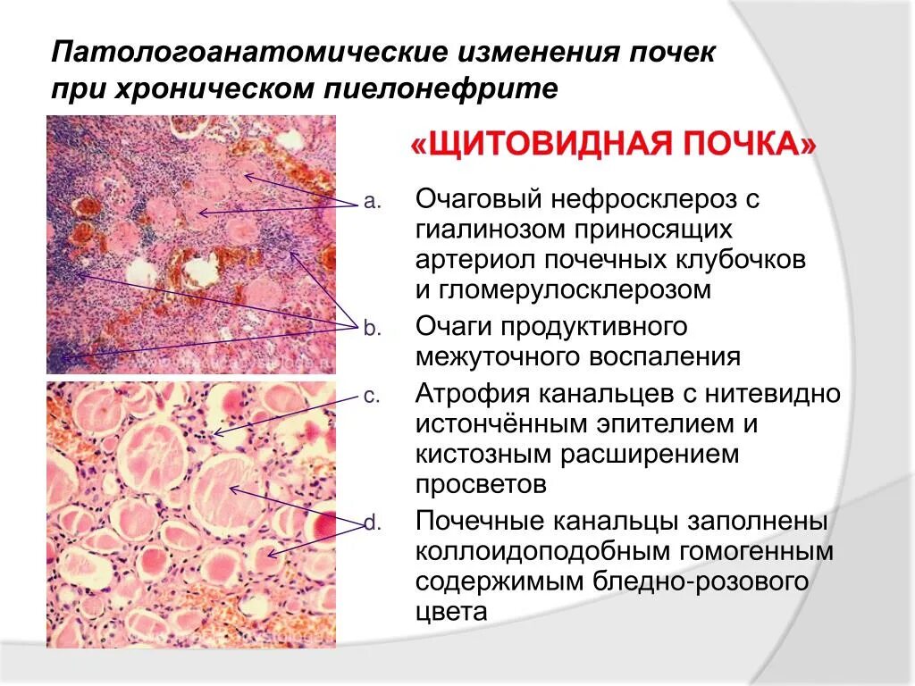 Исход пиелонефрита. Хронический пиелонефрит патанатомия. Хронический пиелонефрит патанатомия препарат. Щитовидная почка микропрепарат описание. Хронический пиелонефрит препарат по патологической анатомии.