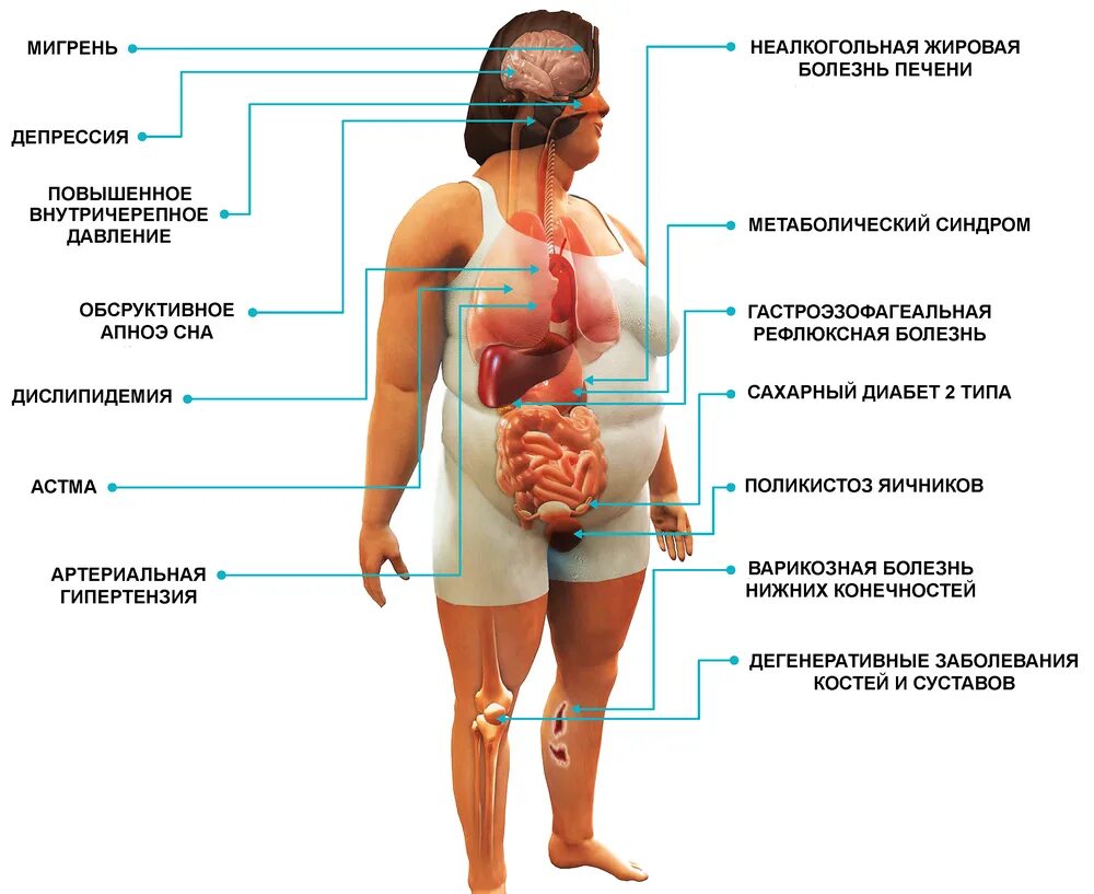 Лишний вес и заболевания. Болезни от лишнего веса. Заболевания при избыточном весе.