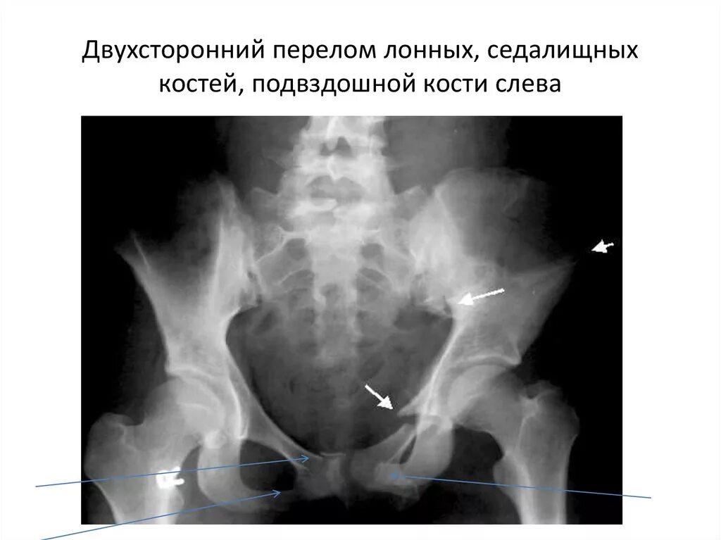Перелом лобковой кости таза рентген. Перелом костей таза рентгенограмма. Рентген подвздошной кости.
