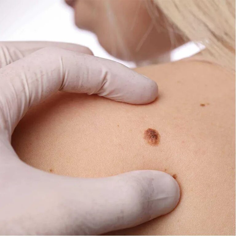 Подошвенные бородавки-шипицы. Папилломы причины возникновения у женщин и лечение. Мироспопилома человека. Впч 16 папилломы у женщин. Инфицирование вирусом папилломы человека.