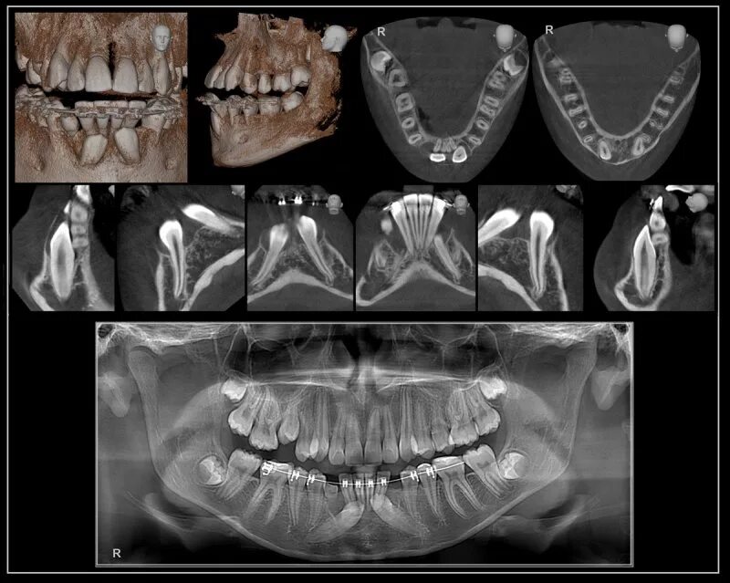 Где сделать кт зуба. Кт 15х15 верхней и нижней челюсти. Кт 3д зубочелюстной системы. Кт 3d верхней и нижней челюсти.
