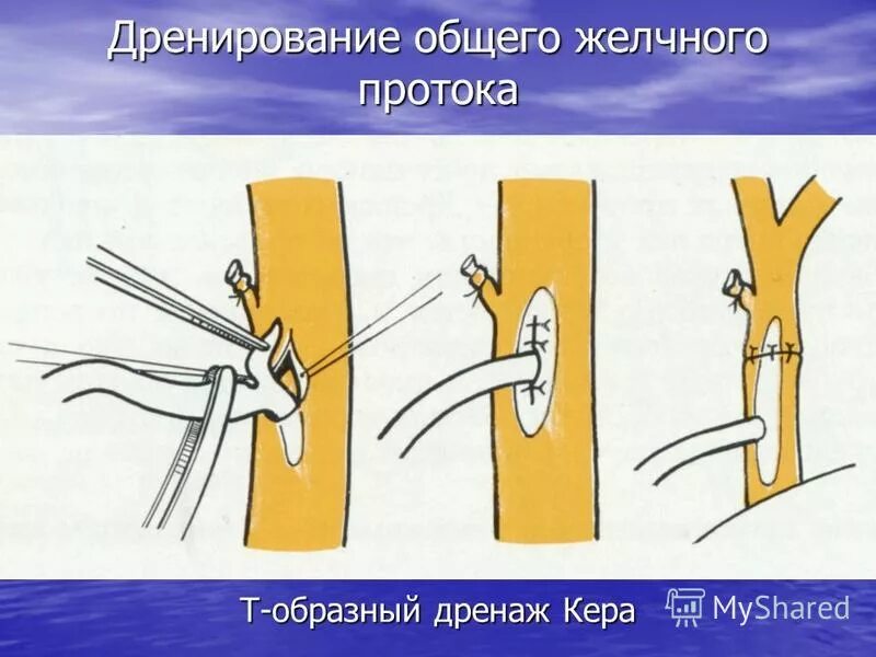 Катетер для дренирования т-образный керра. Тобразное дренироание ходедоха. Трубка дренажная кера силиконовая т-образная. Трубка кера латексная. Т образное дренирование холедоха.
