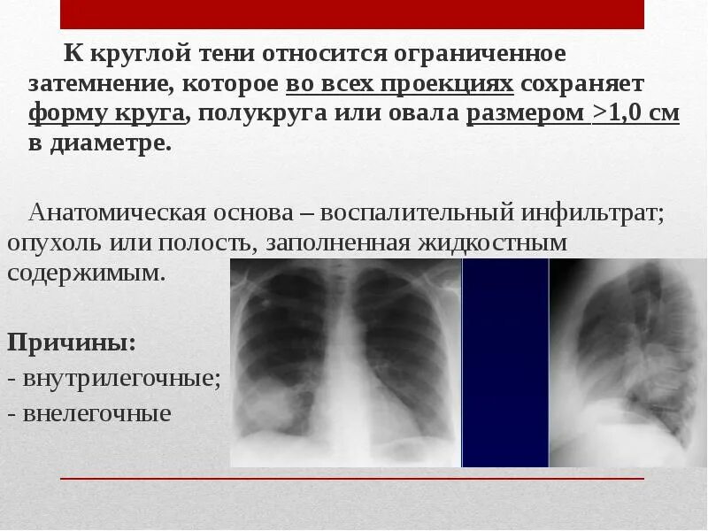 Как ты понимаешь что такое затемнение. Ограниченное затемнение. ограниченное затемнение (инфильтрат). синдром округлой тени дифференциальная диагностика. ограниченное затемнение легочного поля.