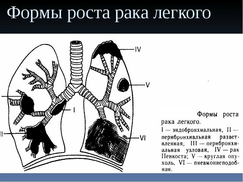 Усиление интерстициального компонента легочного кт. Интерстициальные изменения в легких что это. Интерстициальный компонент легочного рисунка рентген. Интерстициальное поражение легких. Интерстициальный компонент легочного рисунка.