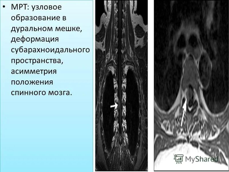 Грыжа деформирует дуральный мешок. Дуральный мешок позвоночника мрт. дуральный мешок спинного мозга. дуральный мешок деформирован. деформация дурального пространства.