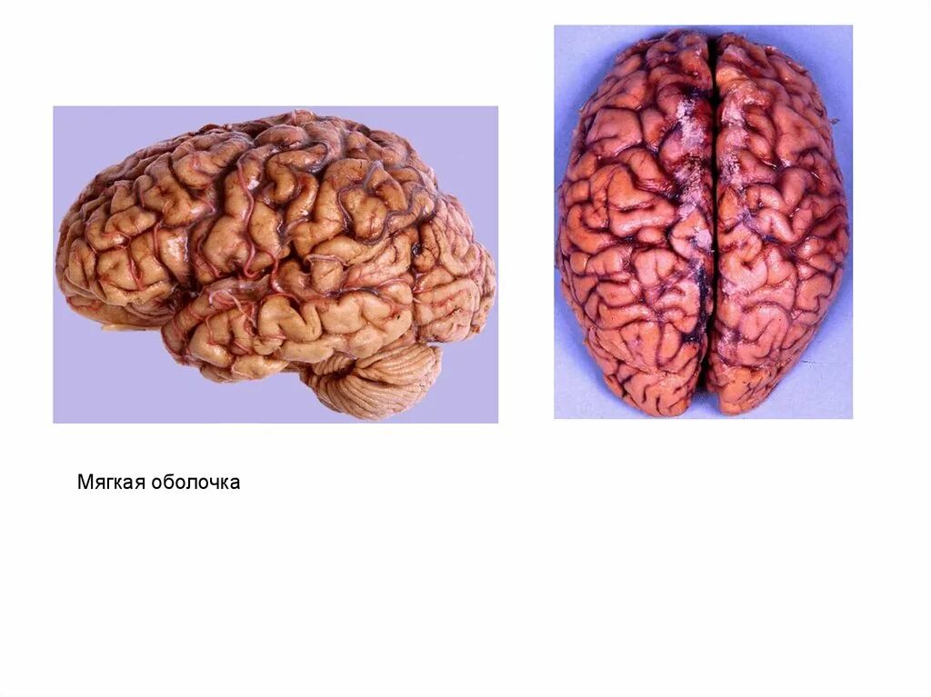 Головной мозг покрыт оболочками. Мягкая оболочка головного мозга. Мягкая мозговая оболочка мозга. Мягкая сосудистая оболочка головного мозга. Головной мозг твердая мягкая.