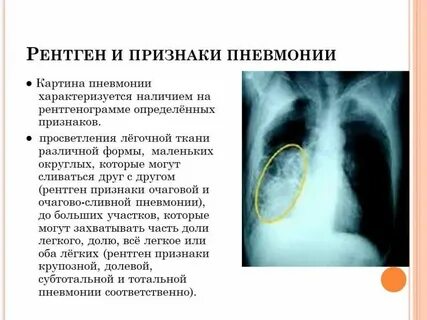 Пневмония симптомы как распознать