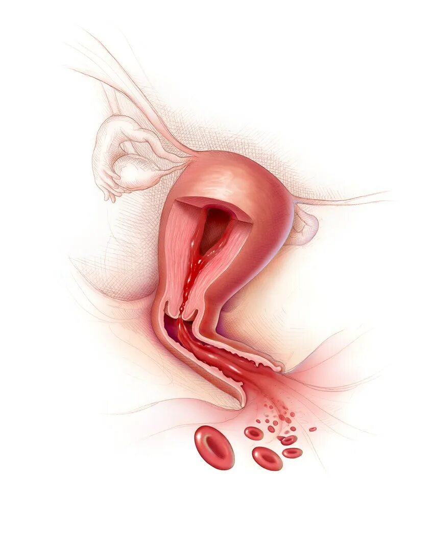 Почему кровь из матки. Вагинальное кровотечение. Послеродовое кровотечение. Послеродовое маточное кровотечение. Акушерские кровотечения.