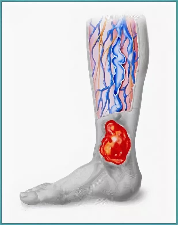 тропическая нога