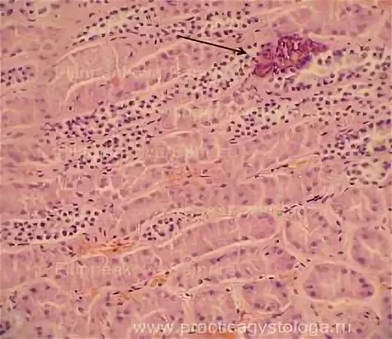 Серозный децидуит гистология. Histology masson. Хориодецидуит гистология. Диффузный серозный децидуит. Хронический децидуит гистология.