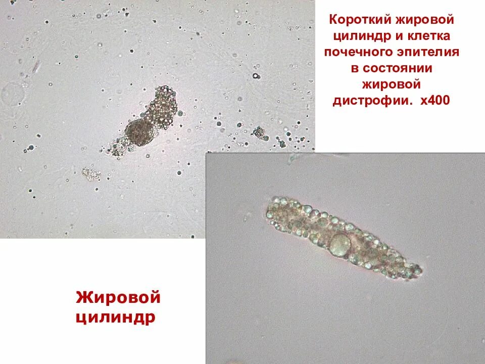 Элементы осадка мочи. Микроскопия осадка мочи эпителий. эпителий в моче микроскопия. микроскопия осадка мочи бактерии. микроскопия осадка мочи плоский эпителий.