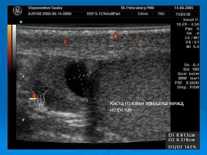 Киста головки у мужчин. Кичта голоаки придатка яич. Киста головки придатка яичка. Киста придатка яичка на УЗИ.