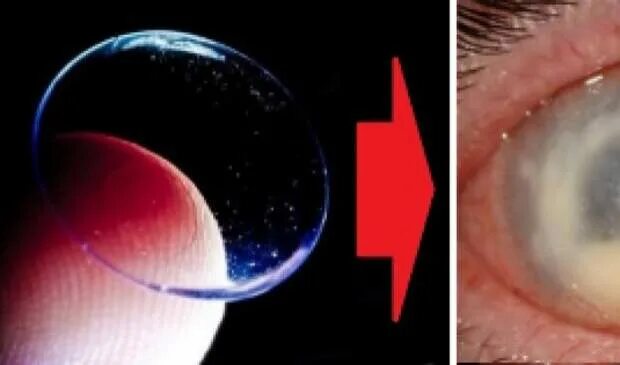 Линзы в воду на ночь. Ночные линзы под микроскопом. Глаза человека который уснул в линзах. Глаза при ношении контактных линз.