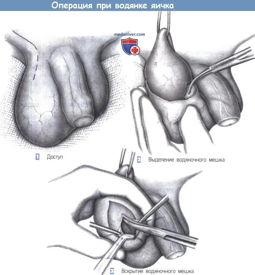 Болит яичко у мужчины. Операция Росса гидроцеле. Операция Бергмана гидроцеле. Операции при водянке оболочек яичка. Операция Росса при водянке яичка у ребёнка.