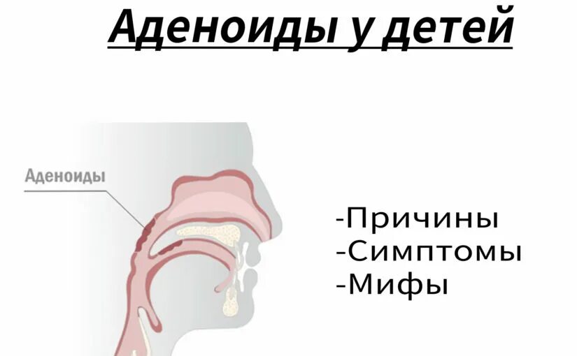 Аденоиды признаки