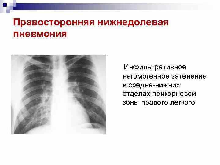 Нижнедолевая очаговая пневмония рентген. Правосторонняя нижнедолевая пневмония рентген. Двусторонняя очаговая пневмония рентген. Правосторонняя очаговая пневмония рентген. Пневмония в нижней доле правого легкого