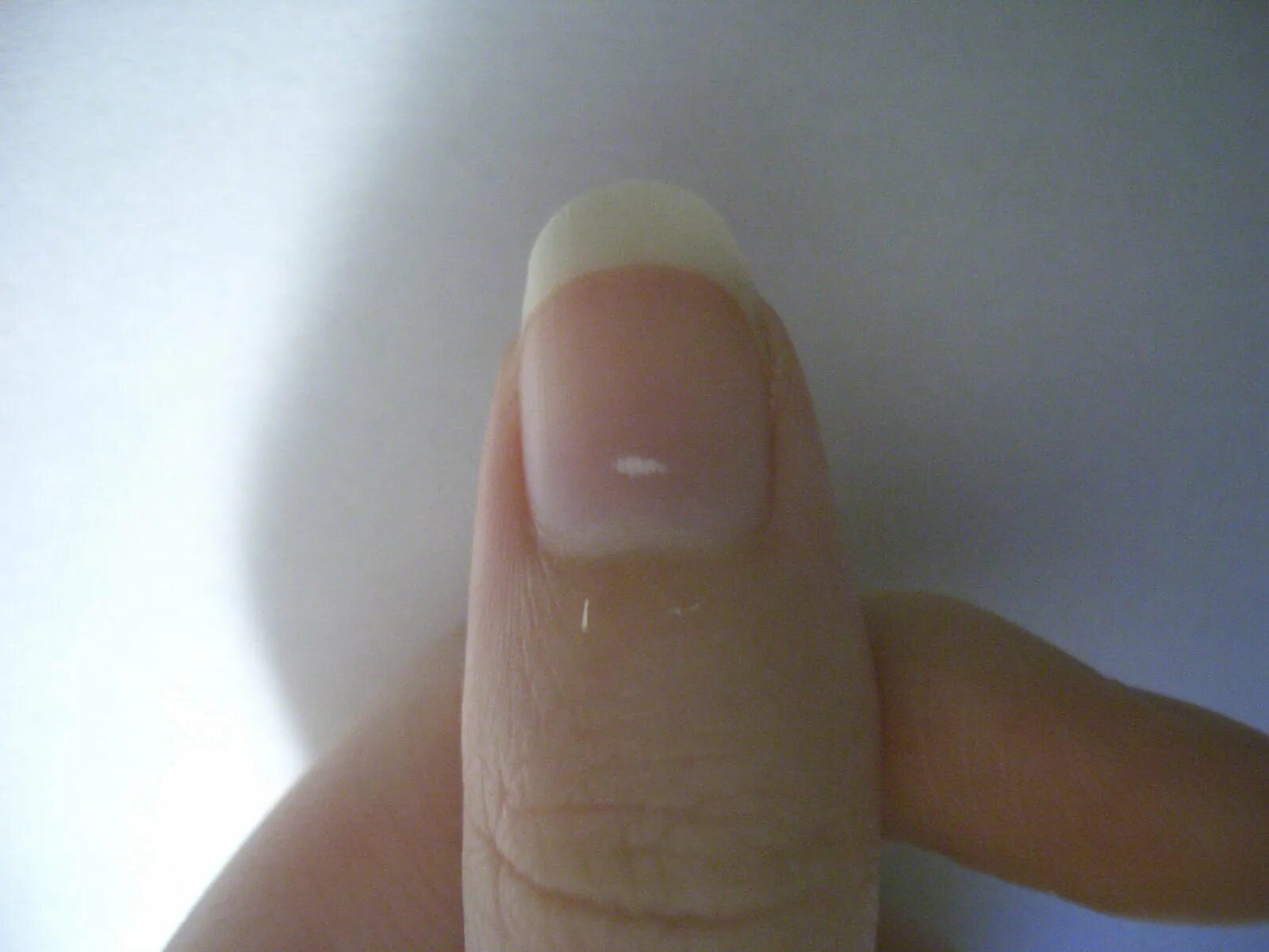 Что означают полосы на ногтях. Поперечная лейконихия. Лейконихия продольная. Лейконихия (белые пятнышки).