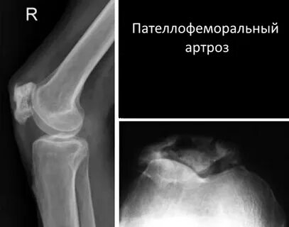 Пателлофеморальный артроз коленного