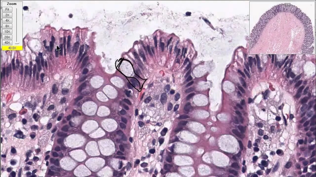 Ткани толстой кишки. Бокаловидные клетки толстой кишки гистология. Гиперплазия толстой кишки гистология. Нормальная слизистая толстой кишки гистология. Дисплазия толстой кишки гистология.