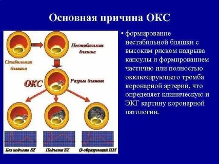 Риск острого коронарного синдрома