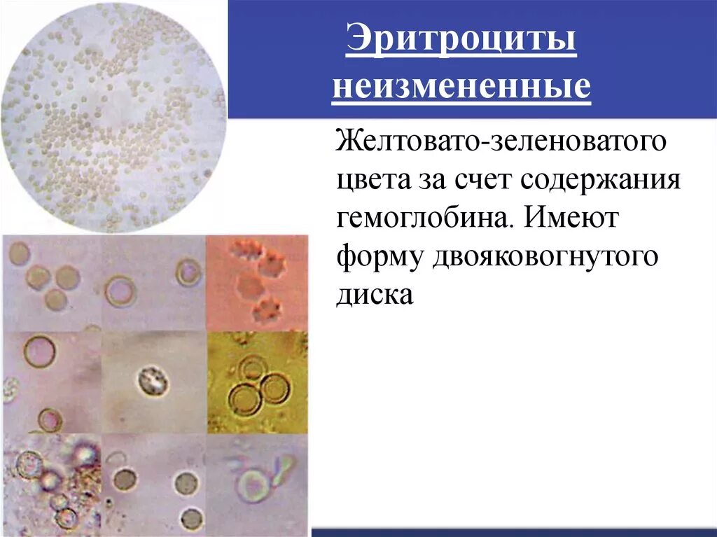 Измененные и неизмененные эритроциты в моче микроскопия. Измененные эритроциты в моче микроскопия. Эритроциты в моче микроскопия. Измененные и неизмененные эритроциты в микроскопии мочи. Появление эритроцитов в моче