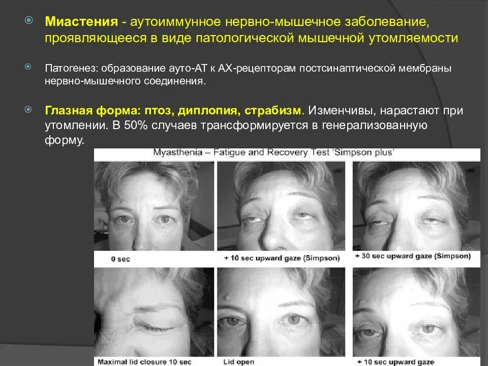 Миастения глазная форма неврология. Глазная миастения симптомы. Формы миастении гравис. Офтальмическая миастения. Псевдопаралитическая миастения.