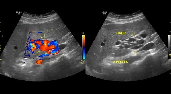 Воротная вена печени на узи. Кавернозная трансформация. Кавернозная трансформация воротной вены на узи. Кавернозная трансформация воротной вены на узи. Узи сонография.