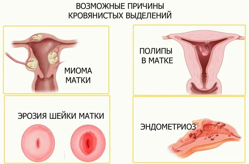 Какие выделения при раке шейки. Выделения из шейки матки. цервикальные выделения.