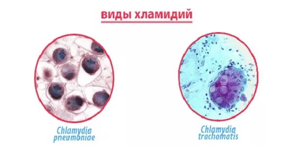 Anti chlamydia trachomatis. Язвы, вызванные хламидией трахоматис. Хламидия пневмония под микроскопом.