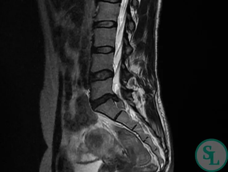 Грыжа диска l5 s1 что это. Грыжа l5-s1. Медианная грыжа l5-s1. Межпозвонковые диски l5-s1. Межпозвонковый диск l5-s1.