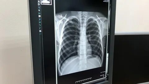 Что лучше сделать рентген легких или кт