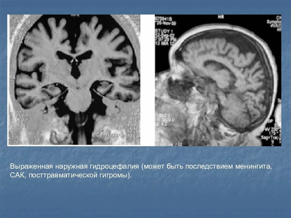 Последствия гидроцефалии головного мозга. Наружная гидроцефалия головного мозга. Наружная гидроцефалия головного мозга мрт. Наружная гидроцефалия головного мозга кт. Наружная внутренняя гидроцефалия мрт.