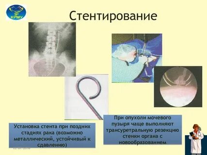 Стент боль при мочеиспускании