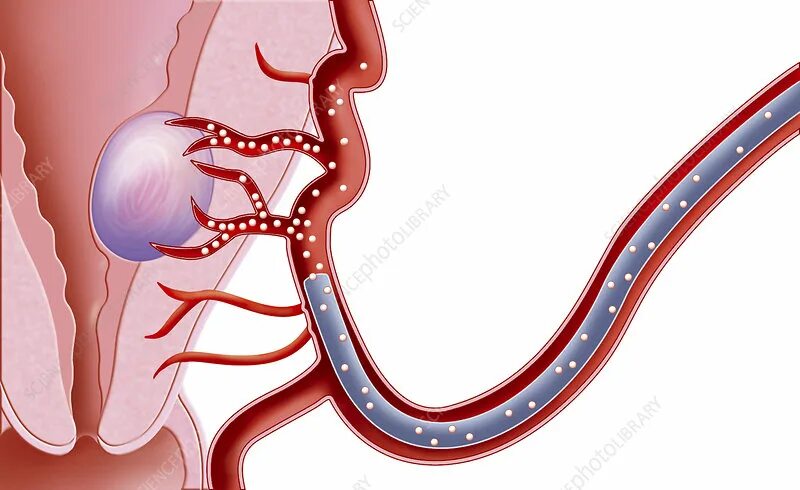 Артерии простаты. Эмболизация кровеносных сосудов. Эмболизация узла.