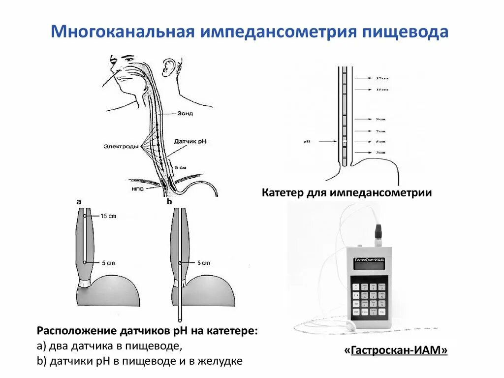 Температура пищевода. Суточная РН импедансометрия пищевода. 24 Часовая PH импедансометрия пищевода. Суточная PH метрия пищевода. Импедансометрия при ГЭРБ.