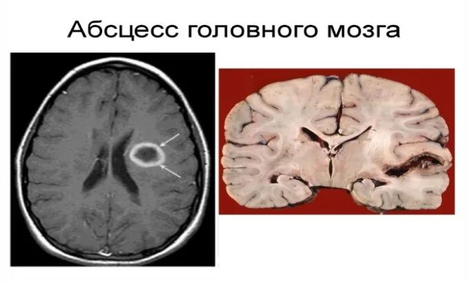 Абсцесс мозга. Абсцесс головного мозга патанатомия. Риногенный абсцесс головного мозга. Абсцесс головного мозга макропрепарат. Субдуральный абсцесс мозга.