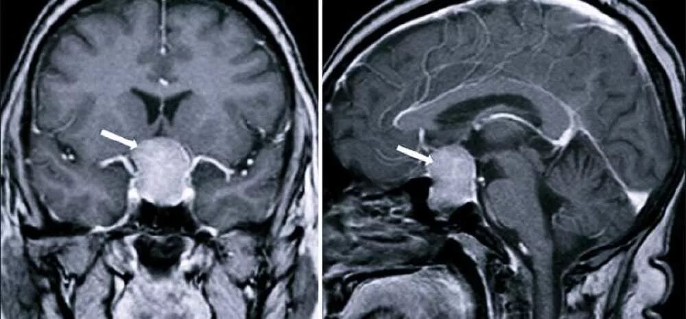 Опухоль гипофиза. Мрт головного мозга аденома гипофиза. Микроаденома гипофиза снимок. Инциденталома гипофиза мрт. Опухоль гипофиза на мрт.