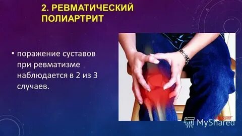 Ревматизм ревматические пороки сердца