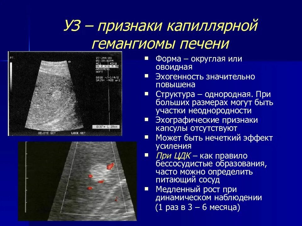 Печень эхогенность неоднородная. Очаговые поражения печени. Очаговый порожения печени.