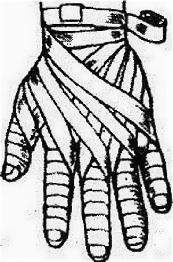 Техника наложения повязки перчатка. Наложение повязки Рыцарская перчатка. Бинтование Рыцарская перчатка. Наложить повязку Рыцарская перчатка. Десмургия повязка перчатка.