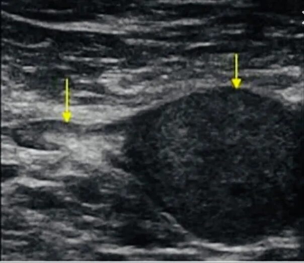 Лимфогранулематоз УЗИ лимфоузлов. Атерома молочной железы на УЗИ. Лимфоузлы молочной железы на УЗИ. Подмышечные лимфоузлы на УЗИ. Лимфоузел неоднородный