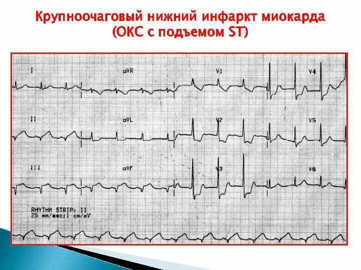 ЭКГ острый инфаркт миокарда с подъемом St. Инфаркт с подъемом ст на ЭКГ. Инфаркт с подъемом сегмента St ЭКГ. ОИМ С подъемом St ЭКГ. Без подъема st на экг