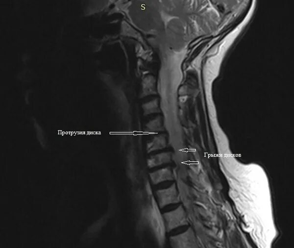 Грыжа 6 мм. Дорзальная протрузия c4 c5 c6. Дорзальная протрузия диска с3-с4. Протрузии шейного отдела с3-с4 с4-с5 с5-с6. Протрузии дисков с3/с4, с4/с5.