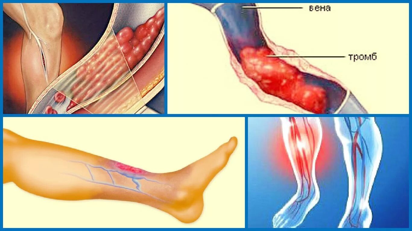 Тромб в артерии симптомы. Септический тромбофлебит. Тромбофлебит нижних конечностей трофические язвы. Флебит тромбофлебит глубоких вен. Тромбоз вен нижних конечностей.