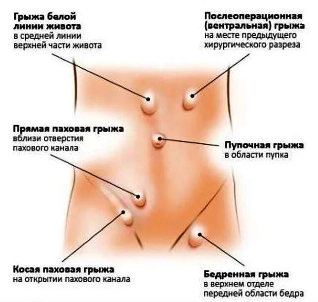 Грыжа спигелиевой линии. Классификация грыжи живота спигелиевой линии. Симптомы грыжи брюшной стенки живота. Грыжа спигелиевой линии живота операция. Болит низ живота после операции