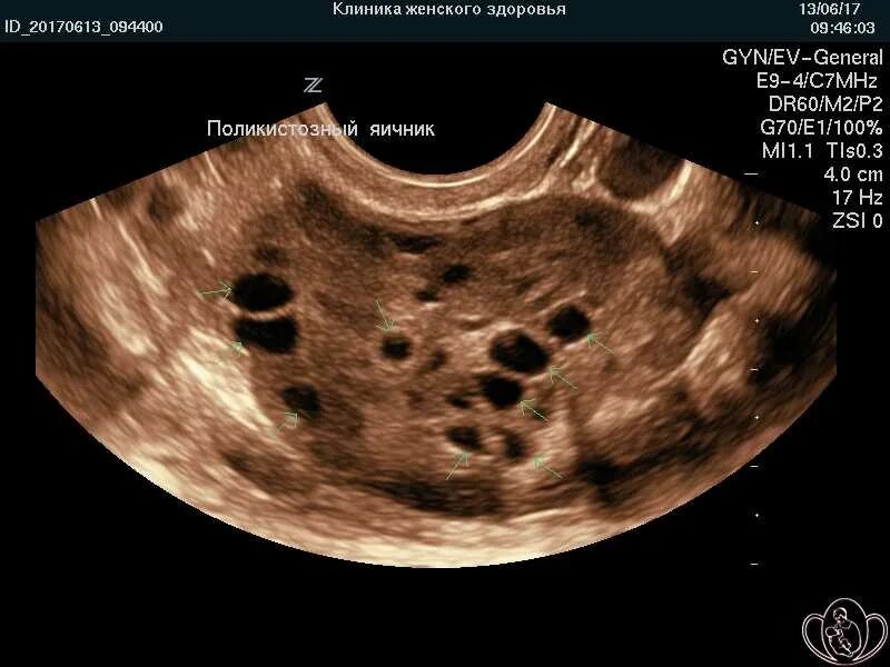 Синдром поликистоза яичников на УЗИ. Мультифолликулярные яичники на УЗИ. Мультифолликулярные поликистоз яичников. Поликистоз яичников (СПКЯ).